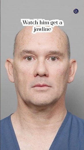 Look at His New Jawline | Facelift & Neck Lift Results #beverlyhillsplasticsurgery
