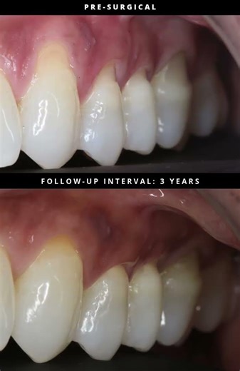 Clinical Observation — Gingival Recession