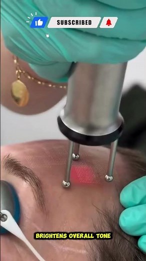 Cool Laser: Fractional Resurfacing for Smooth, Radiant, and Youthful Skin