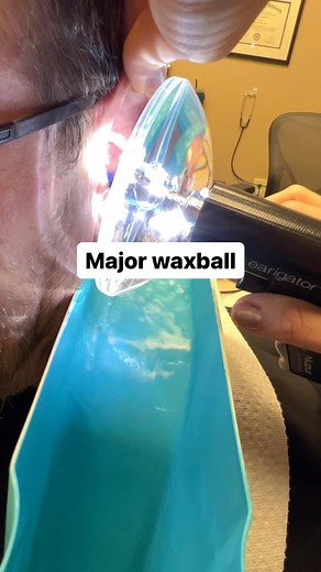 6.7K views · 19 reactions | Major wax ball vibes #earwax #waxremoval #earcleaning #drpimplepopper #pimplepopping #bath #drearwax #irrigation #earigator | Dr_Ear_Wax | Facebook