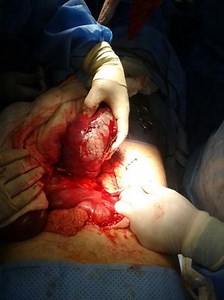 Cecal volvulus | Radiology Reference Article | Radiopaedia.org