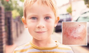 Slapped cheek syndrome: The childhood disease can show up in the sun