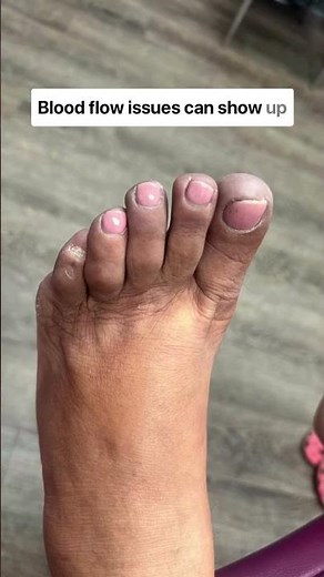 Purple Toes? It Could Be a Sign of Peripheral Artery Disease (PAD)!