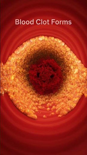 What Happens When an Artery Gets Blocked? | Heart Attack & Stroke Explained in 3D
