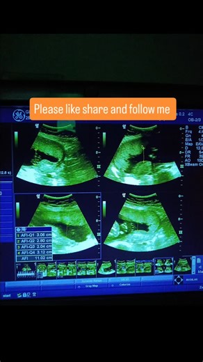 0000000000 on Instagram: "Measurement the Amniotic fluid index (AFI) #viralreels #flowers #kids #japan #hospitals"