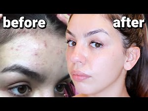 HOW I CLEARED MY SKIN | BENZOYL PEROXIDE FOR ACNE