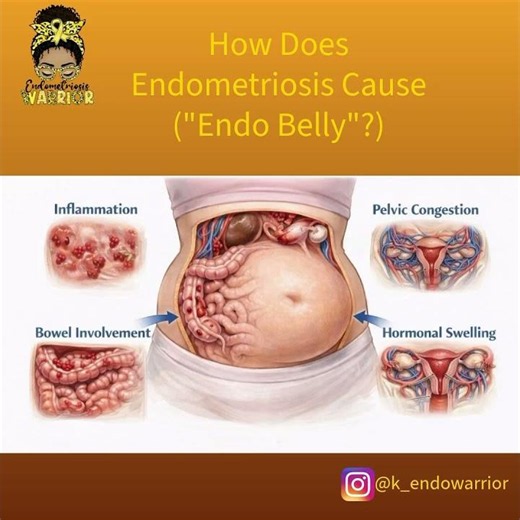 How does endometriosis cause endo belly? #fyp #iam1in10🎗️ #k_endowarrioronIG
