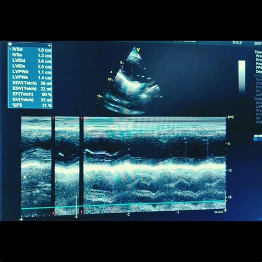 Normal 2D ECHO STUDY With M mode cut value