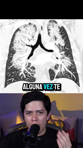 Dr. Jonah Serrano | Radiología on Instagram: "Fisiopatología del edema pulmonar agudo cardiogénico y sus manifestaciones por radiografía y tomografía. #radiologia #SALUD #radiology #tomografia #estudiantesdemedicina #diagnosticomedico #médico #cirugia #radiolology"