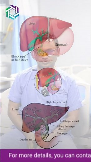 What is PTBD and How Does It Unblock Bile Ducts? | Jaundice treatment option | Dr Praveen Kammar