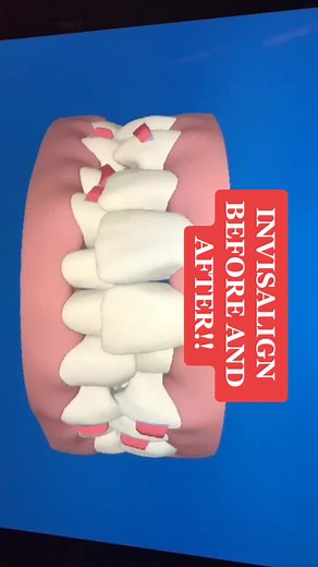 INVISALIGN before and after! #invisalign #braces #smile #teeth #align #orthodontics