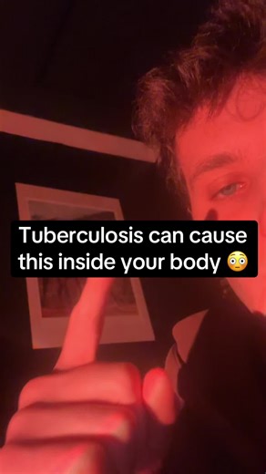 Recognizing Tuberculosis Symptoms for Early Treatment