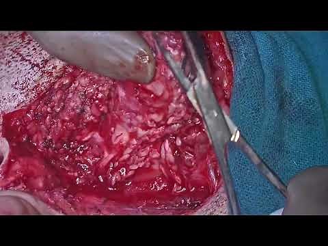 Superficial Parotidectomy by Prof Dr Jaskaran singh and Dr Bhanu Bhardwaj