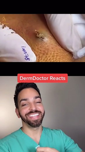 #pimplepopping #dermatologist #acne #cyst | Doctorly