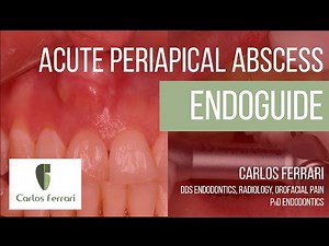 Acute Periapical Abscess and Endoguide