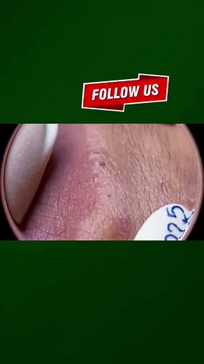 Pimple Satisfying on TikTok