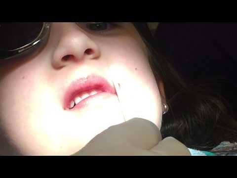 Superfloss SDF Tutorial for interproximal cavities using Advantage Arrest Silver Diamine Fluoride 38