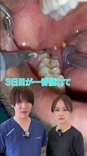 【親知らずQ＆A】親知らずの抜歯は腫れる？腫れない？腫れな法方法はある？ #aclinicデンタル #親知らず #歯並び
