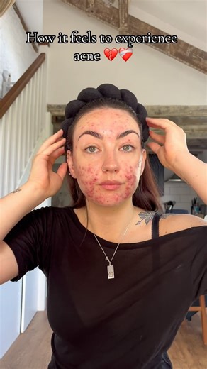 Lexi Jenkinson on Instagram: "My heart goes out to you all going through the same thing 🫶 #acne #anxiety #acnescars #selflovejourney #acnefighter #acnejourney"