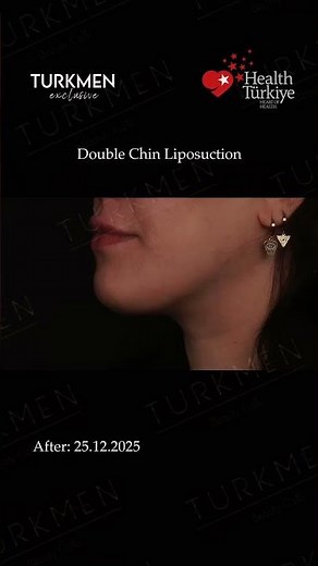 Laser liposuction reduces double chin fat and supports skin tightening #laserlipo #doublechin