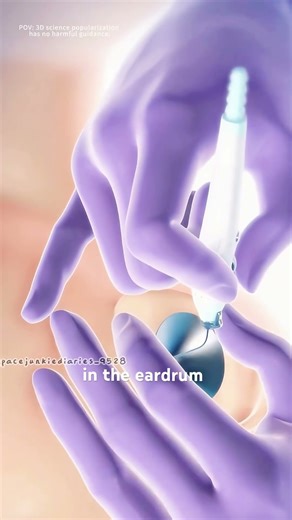 Ear tube placement (Tympanostomy tubes)3D animation #music #motivation #epic #like #reels #newreel