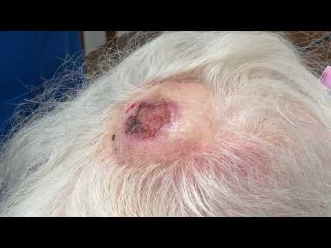 Profound Hemostasis with TEL for 95 Year Old with SCC