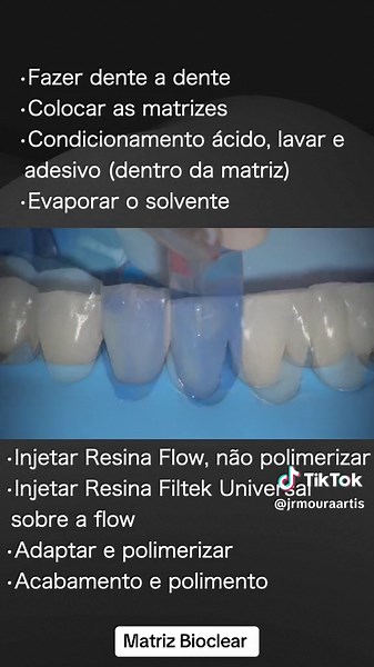 Matrizes BT da Bioclear: Solução para Black Spaces
