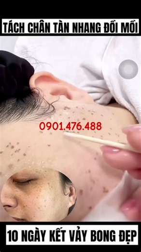 Freckle removal after 7 days, peeling off #0901476488 #beauty #melasma #freckles