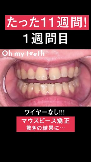 マウスピース矯正: おうちで過ごし隊にオススメの方法