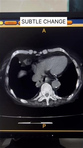 CT Scan Spot the Finding Chest Abdomen Junction #shorts