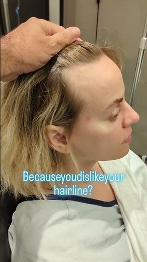 hairline lowering surgery also known as forehead reduction surgery using scalp advancement