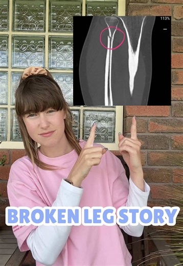 Well, this is how you break a bone just by running, for anyone who was curious 🧐 #run #marathon #injury #fibula #fracture