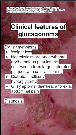 Clinical features of glucagonoma
