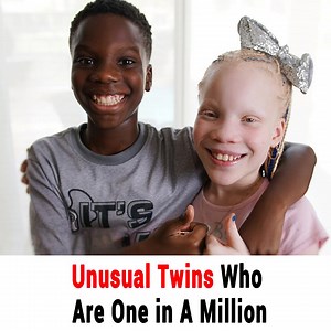 When it concerns twins, the most common question is if they are fraternal or identical. However, there have been instances of twins being born with complexities far from that. The concept of twins may be strange but there are even stranger twins in the world with features that seem bizarre. There are twins, who could be conjoined in such ways with separation impossible, and there are twins that aren’t technically twins at all, yet they are. Well, the world is indeed complex when it comes to twin