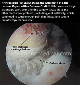 Non-surgical Treatment of Acetabular or Hip Labral Tears