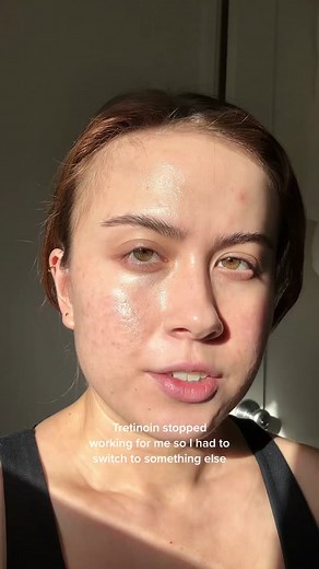 Tazarotene for Acne: My Results After Tretinoin Stopped Working