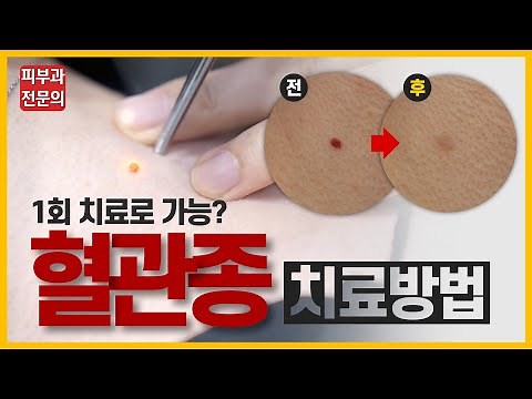 Today's video is all about hemangioma laser treatment method and actual treatment results!