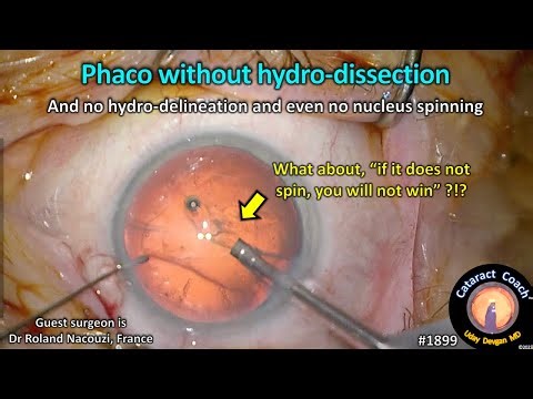 CataractCoach™ 1899: phaco without hydro-dissection or nucleus rotation