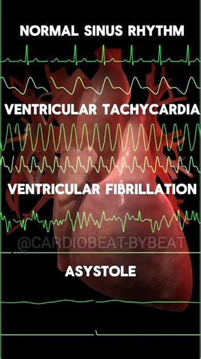 🔹ACLS Cardiac Arrest Algorithm:Shockable vs. Non-Shockable Rhythm Pathway ⚡ · Shockable: VF/VT. Treat with immediate defibrillation. · Torsades de Pointes is a polymorphic VT. Defibrillate if pulseless. Correct underlying causes (e.g., hypomagnesemia, long QT). · Non-Shockable: PEA/Asystole. Treat with CPR, Epinephrine, and reversible causes (Hs & Ts). Cycle: 2 min CPR → Rhythm Check → Act. #TorsadesDePointes #PolymorphicVT #CardiacArrest #ACLS #ECG VF VT PEA Asystole Resuscitation Cardiology C