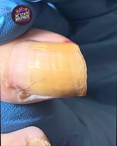 Best Nail Practices for Overgrown Toenails To Avoid Complications #FootCareTips #HomeNailCare #FootWellnessUSA #SafeNailCare | NC State Wolfpack on TheWolfpacker.com