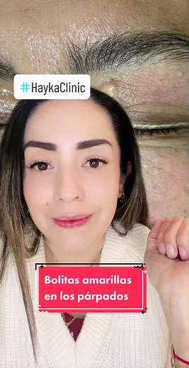 El xantelasma palpebral es una pequeña acumulación de grasa bajo la piel del párpado inferior o superior, sobre todo cerca del lagrimal. Su color suele ser amarillento y se sitúa en la capa superficial y media de la piel, por lo general no afecta a la órbita del ojo. Aparecen con más frecuencia en personas adultas con estrés, depresión o con ciertos trastornos metabólicos como pueden ser: Diabetes Cirrosis biliar Hipercolesterolemia Aunque también es posible que aparezcan en personas que no pres