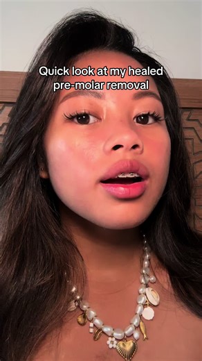 Premolar Extraction Healing Progress: A 2-Week Update