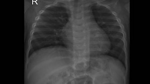 High-resolution X-ray Human Chest Stock Footage Video (100% Royalty-free) 3525509491 | Shutterstock