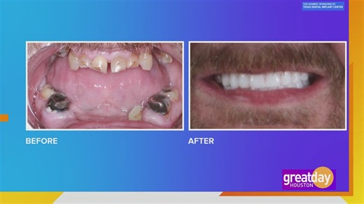 Sponsored: How the Texas Dental Implant Center can give you the smile of your dreams