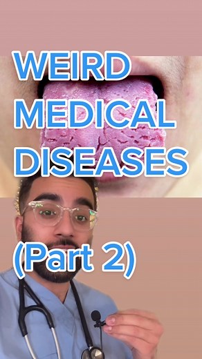 Understanding Fissured Tongue: Causes and Types Explained