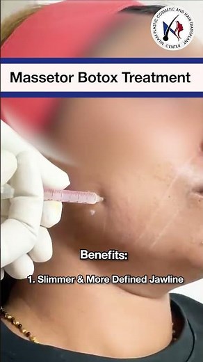 Jawline Transformation with Masseter Botox 💉 | Non-Surgical Face Slimming | Nilam Clinic Ranchi