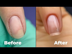 How I Repair Severe Onychosis Nails Using Fiberglass & Builder Gel