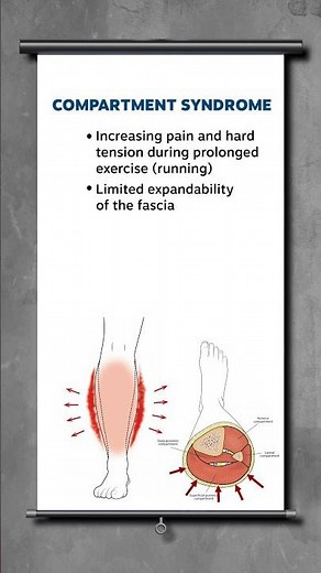 Compartment syndrome explained