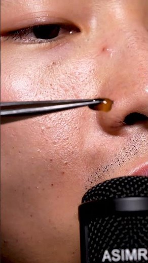 “Most Satisfying Blackhead Pops EVER Recorded (Real ASMR Sounds)”