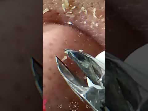 Acne Treatment & Blackhead Removal | Very Satisfying Pimple Popping #331